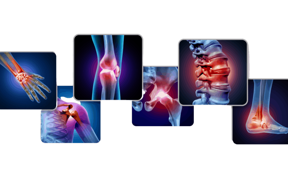 Arthritis Pain and Rehabilitation
