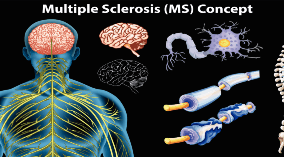 Multiple Sclerosis - Buffalo Occupational Therapy - Outpatient occupational therapy