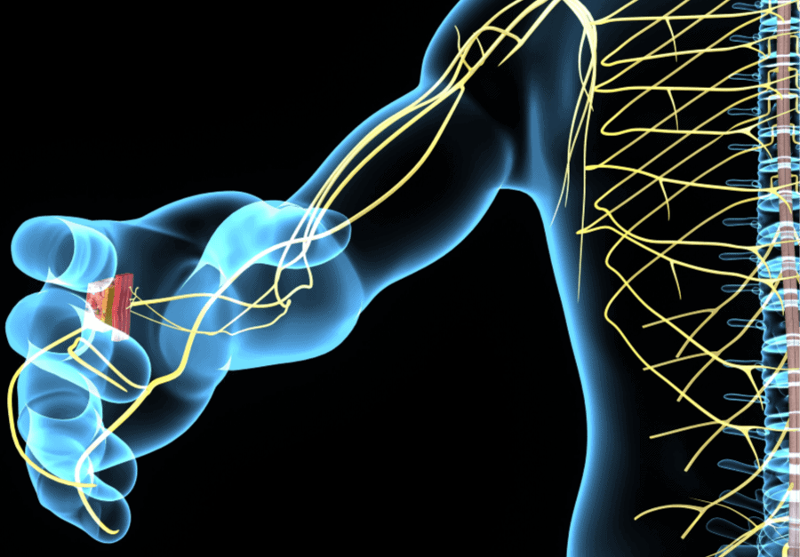 Parkinsons disease nerve synapses Neurological Rehabilitation - Buffalo Occupational Therapy Parkinsons disease nerve synapses Neurological Rehabilitation - Buffalo Occupational Therapy