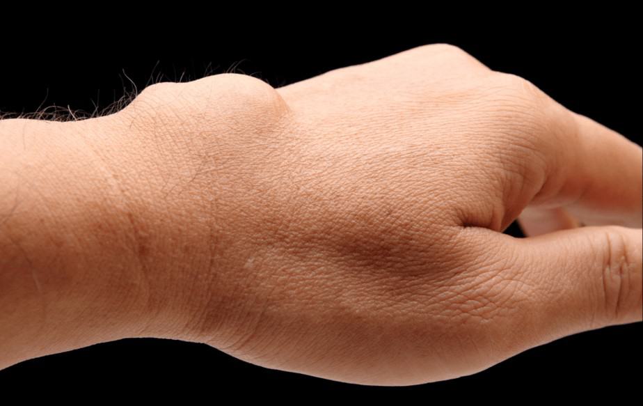 Ganglion Cyst Rehabilitation Therapy