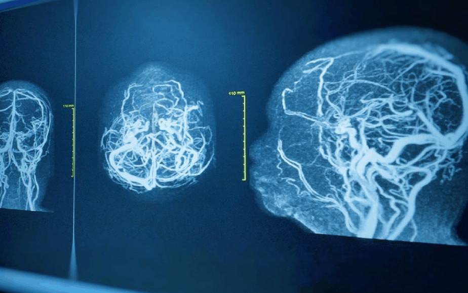 Progressive Neurological Disorders – Whole Body Therapy