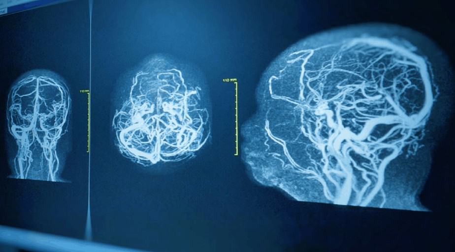 Progressive Neurological Disorders - Buffalo NY Progressive Neurological Disorders - Brain with degeneration - Buffalo NY