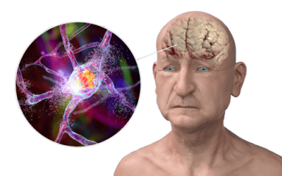 Stages of Alzheimer’s Disease