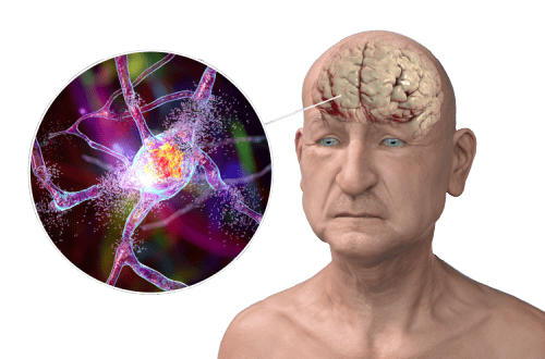 Stages of Alzheimer’s Disease